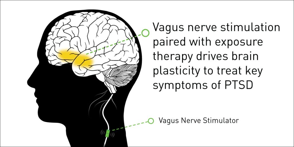 Study: Vagus Nerve Stimulation Shows Progress Against PTSD Symptoms