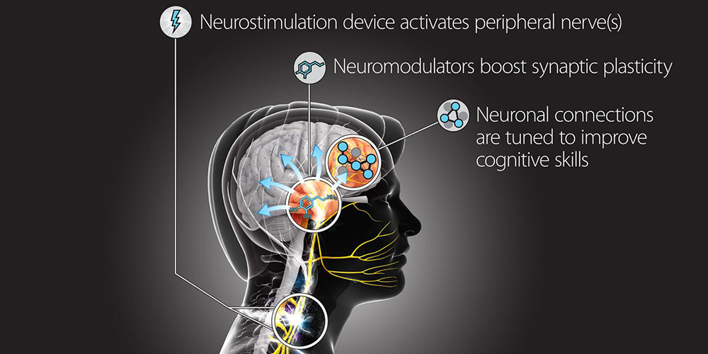 Graphic showing the effect of neurostimulation