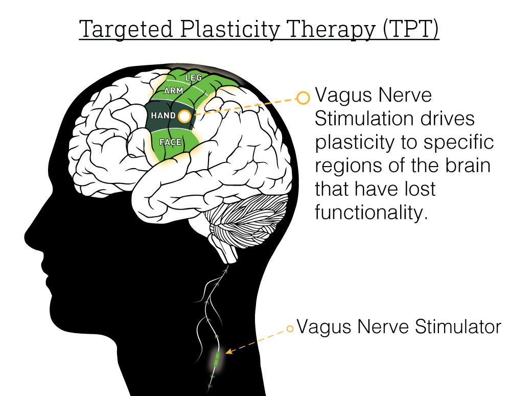 An illustration of Targeted Plasticity Therapy and its effect on the brain, reading "Vagus Nerve Stimulation drives plasticity to specific regions of the brain that have lost functionality.