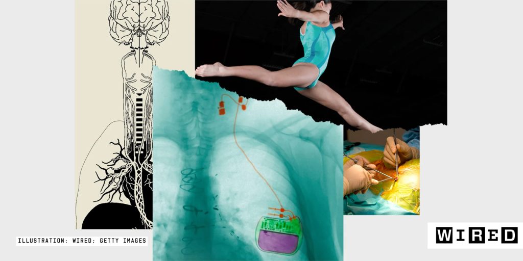 Illustration of a ballet dancer, surgeons, spinal column/nervous system and an implantable device